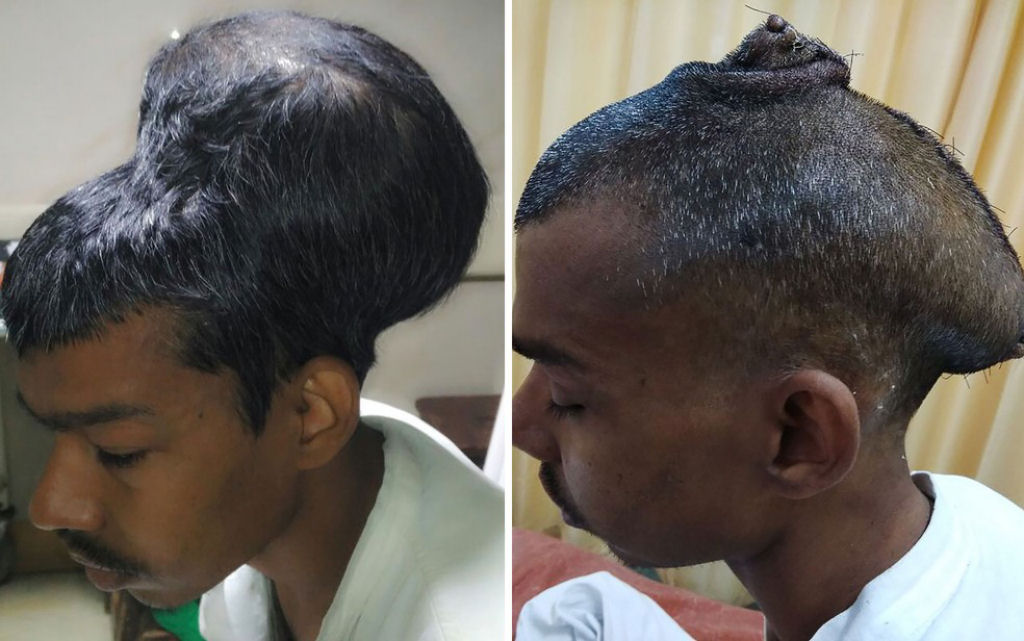 Uma cabea sobre outra cabea: conseguem extirpar com sucesso o maior tumor cerebral do mundo