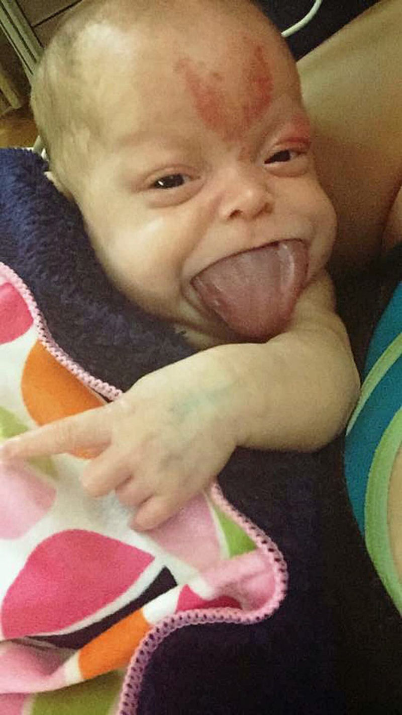 Recém-nascida com língua enorme sorri pela primeira vez após a cirurgia de redução 04
