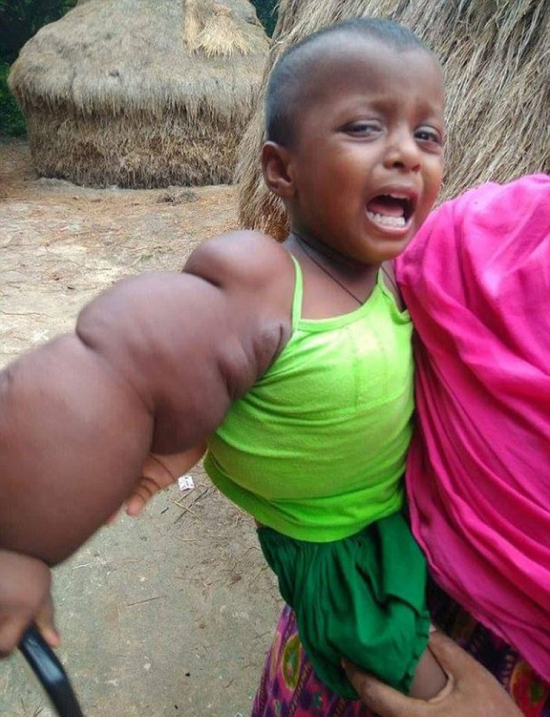Garotinha de 2 anos mal pode caminhar com seu braço que pesa 3kg