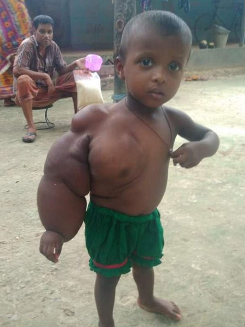 Garotinha de 2 anos mal pode caminhar com seu braço que pesa 3kg