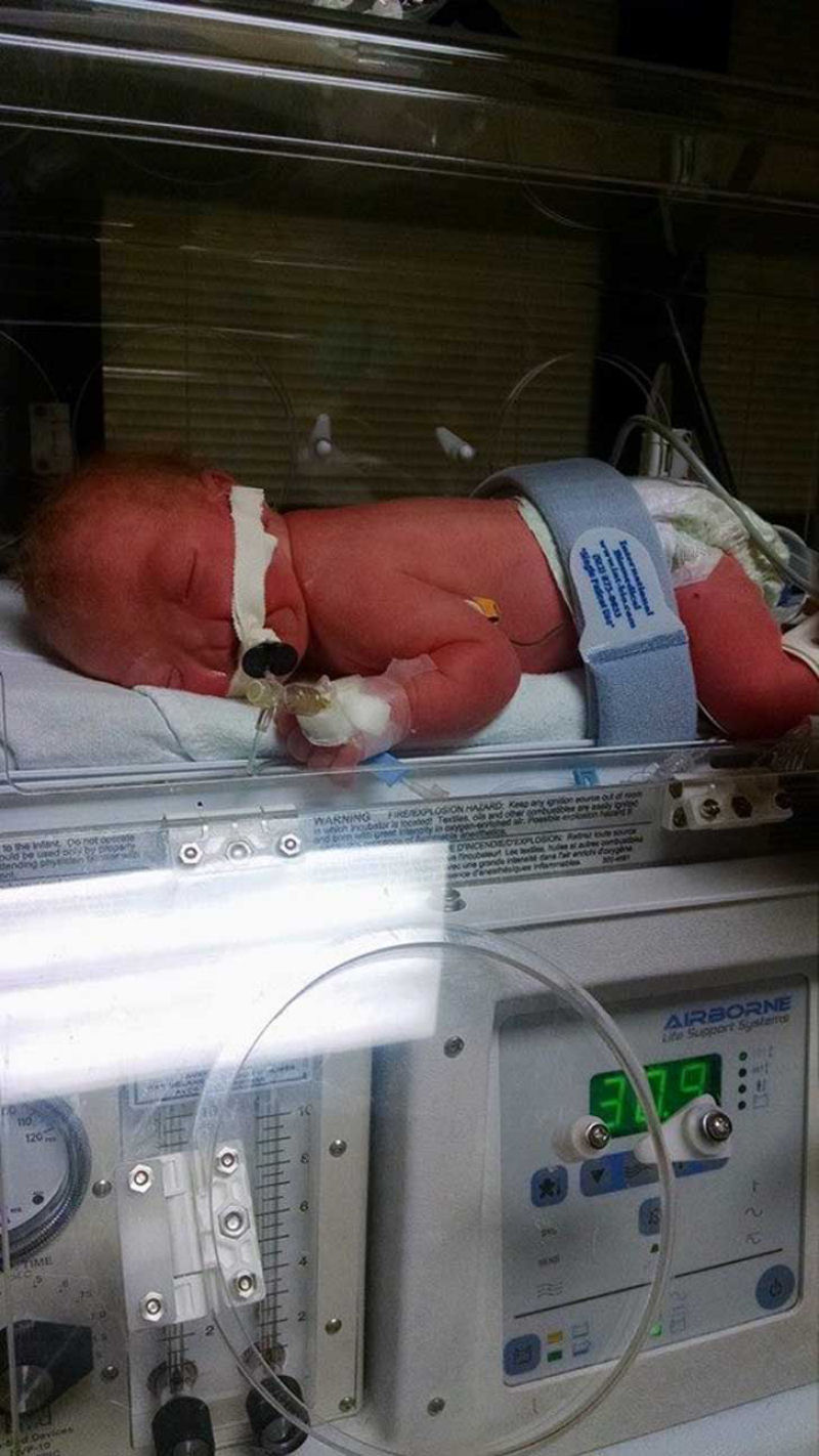 As probabilidades de que este beb sem nariz derreta seu corao so de 100% 07