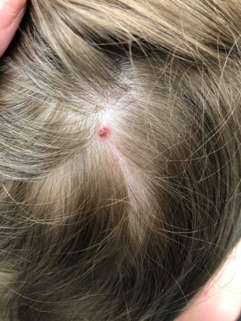Uma menina de 5 anos sofre paralisia repentina aps receber uma picada de carrapato na cabea