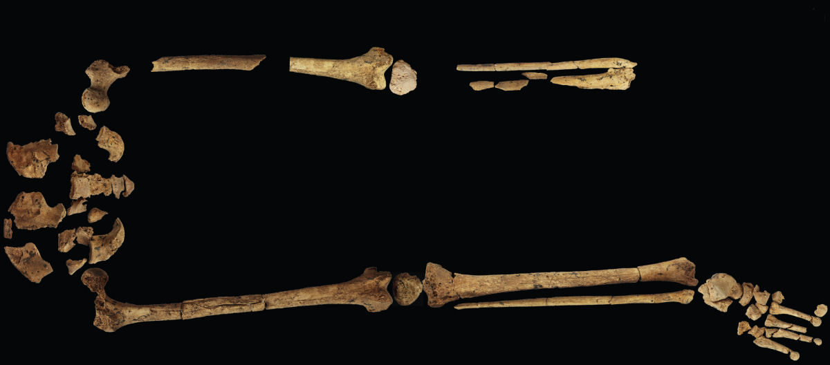 Este esqueleto  a prova de que os humanos j amputaram membros por razes mdicas h 31.000 anos