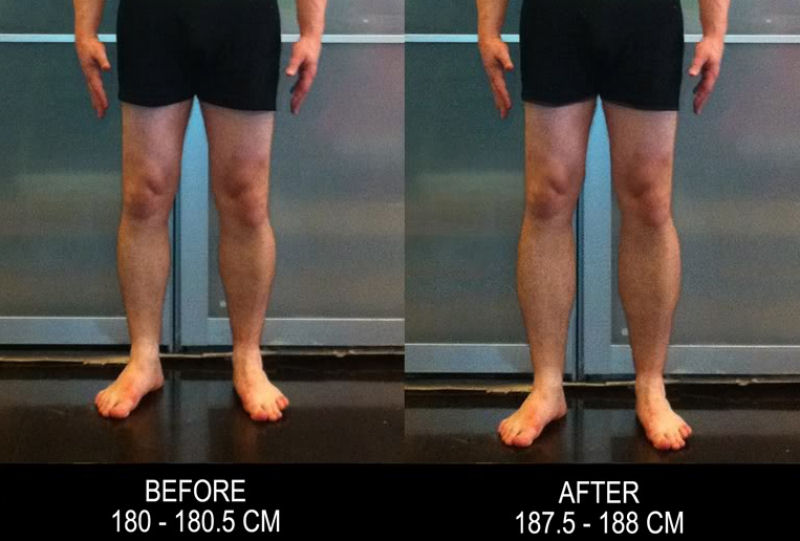 Quebrando as pernas por alguns centmetros extras, uma tendncia crescente no mundo da cirurgia esttica