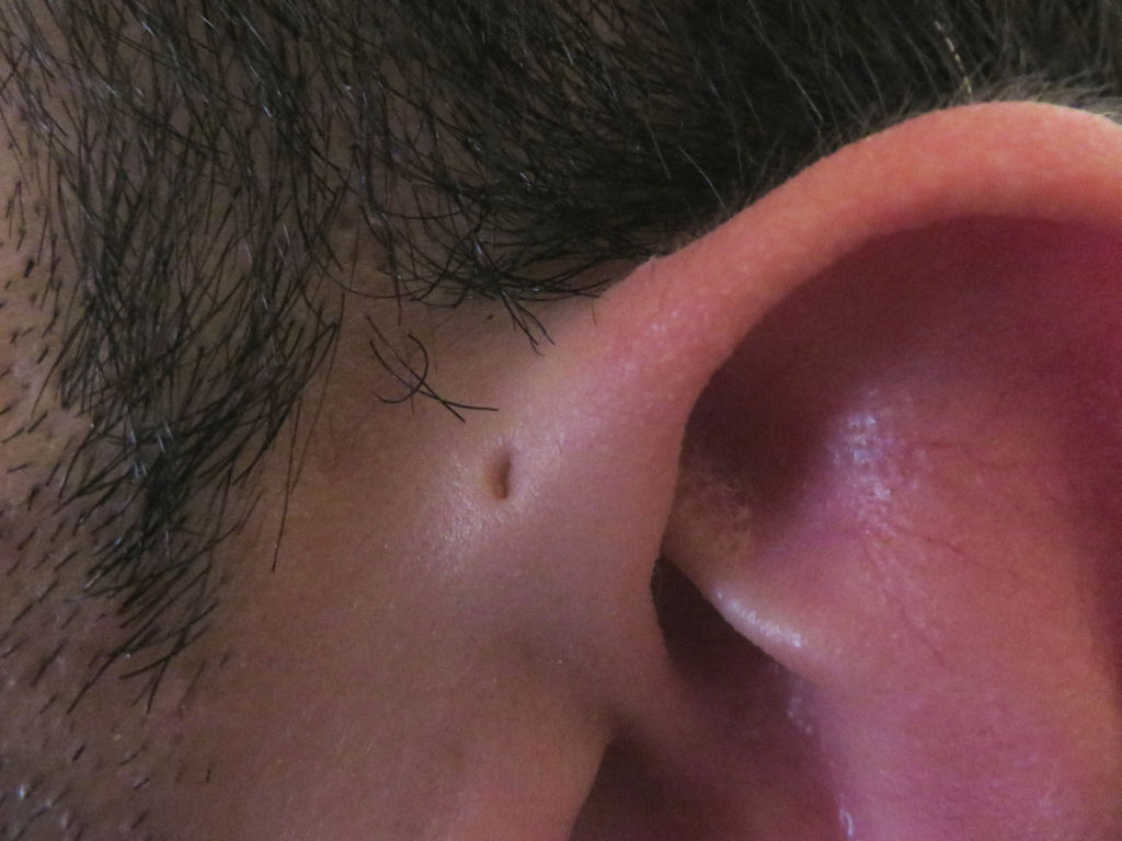Por que algumas pessoas têm um pequeno furo extra na orelha?