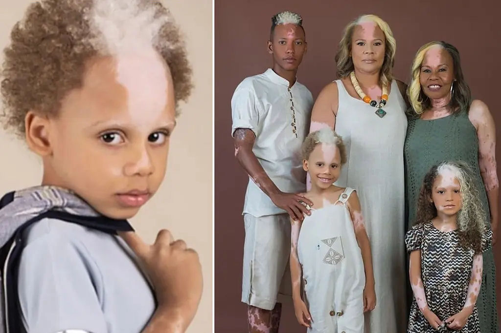 Por que algumas pessoas nascem com mechas de cabelo branco?