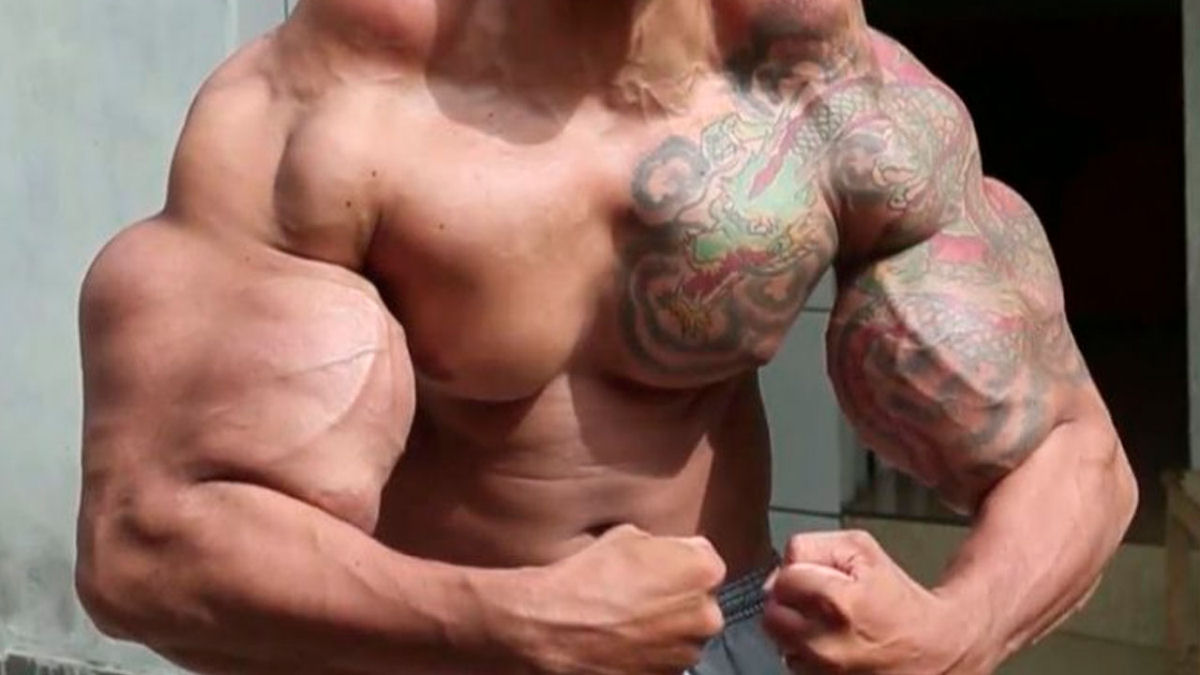 Por que alguns 'fisiculturistas' continuam usando Synthol, apesar do risco que representa?