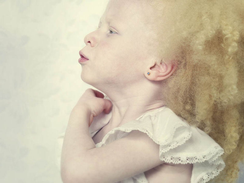 Albinos, um belo trabalho de fotografia 16