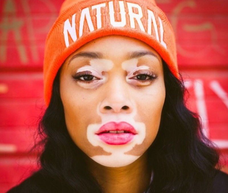 Jovem com vitiligo torna-se uma modelo de sucesso
