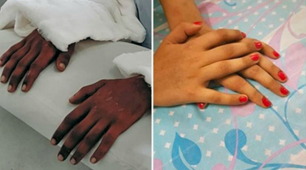 O curioso caso da garota duplamente amputada cujas mos transplantadas mudaram de cor