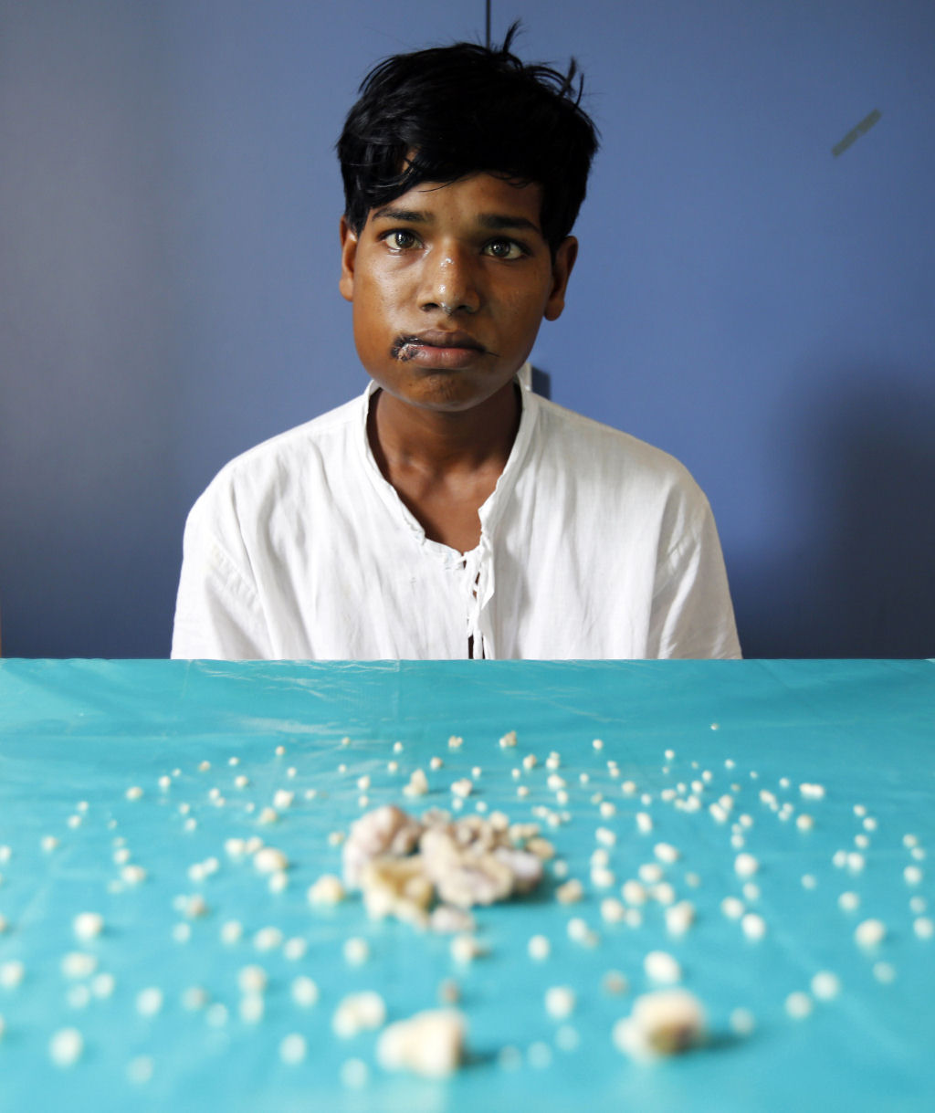 Médicos extraem 232 dentes da boca de um jovem indiano