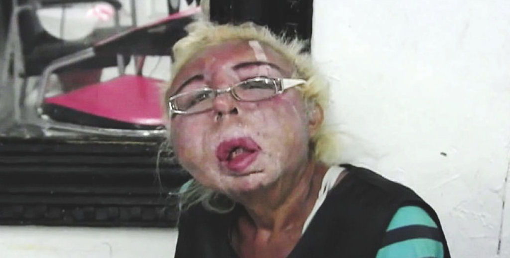 Homem injeta produtos domsticos no rosto e termina desfigurado