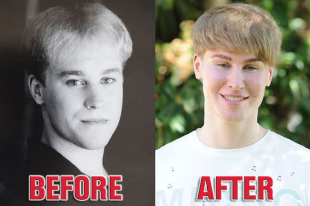Homem investe 100 mil dólares e 5 anos de cirurgias plásticas para parecer-se com Justin Bieber 06