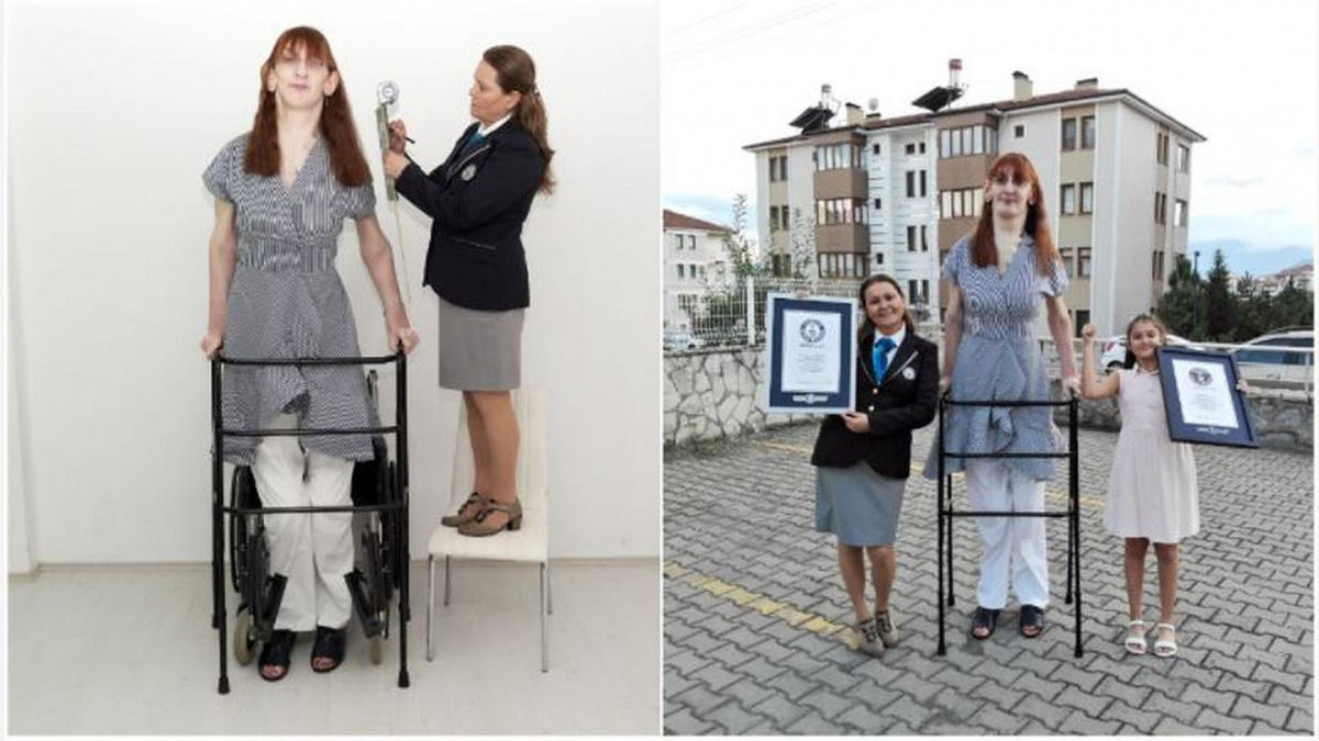 Rumeysa Gelgi, a mulher mais alta do mundo tem a síndrome de Weaver