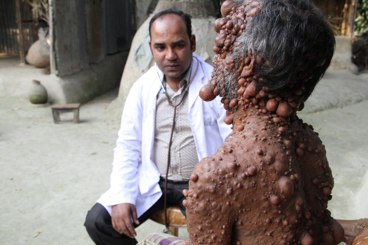 Bengali com centenas de tumores no corpo diz que não poder sair à rua porque as crianças tem medo dele