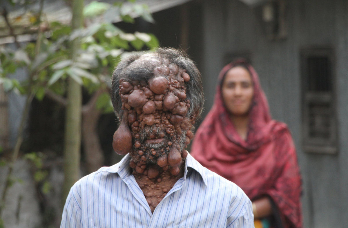 Bengali com centenas de tumores no corpo diz que não poder sair à rua porque as crianças tem medo dele
