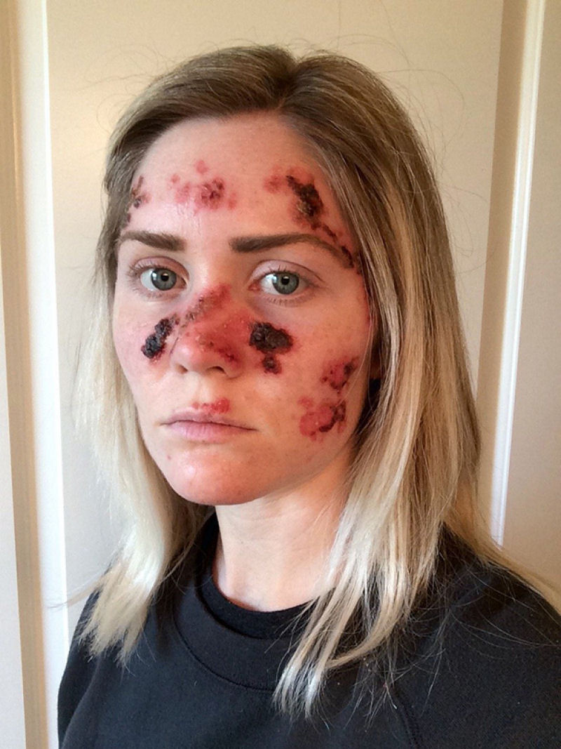 Esta garota com cncer de pele publicou um impressionante selfie para advertir sobre os perigos do bronzeamento