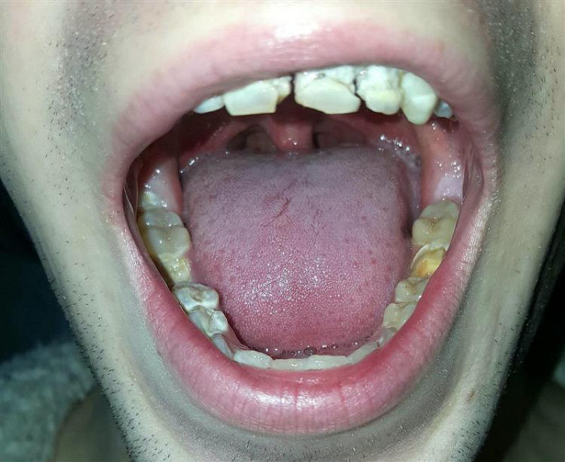 Jovem britnico perde os dentes depois de tomar 6 latinhas dirias de energtico durante meses