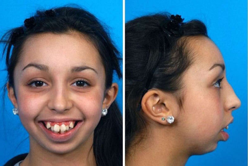 Depois de operar a mandbula esta garota parece outra pessoa