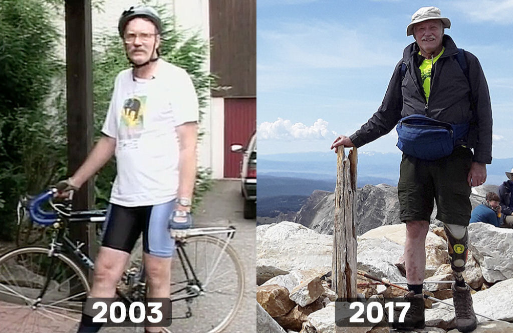 «Há 8 anos tenho só uma perna, sou feliz»: homem amputou a perna porque sim