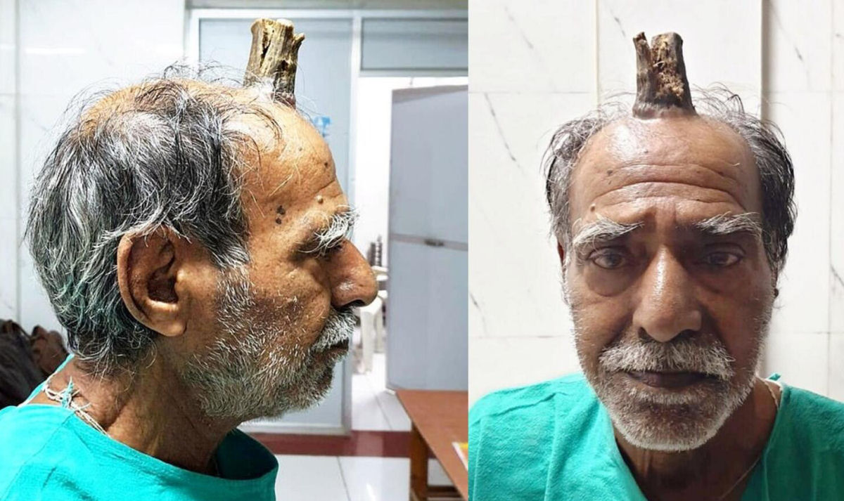 Aps leso, agricultor indiano desenvolve um grande chifre no meio da cabea