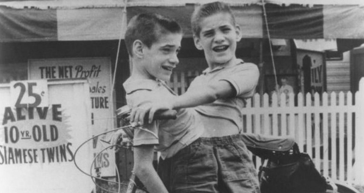 Donnie e Ronnie: os mais antigos gêmeos siameses sobreviventes do mundo