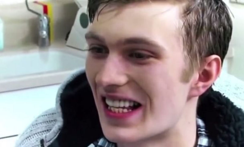 Jovem mostra a extensão do dano de seus dentes depois de não escová-los por 20 anos