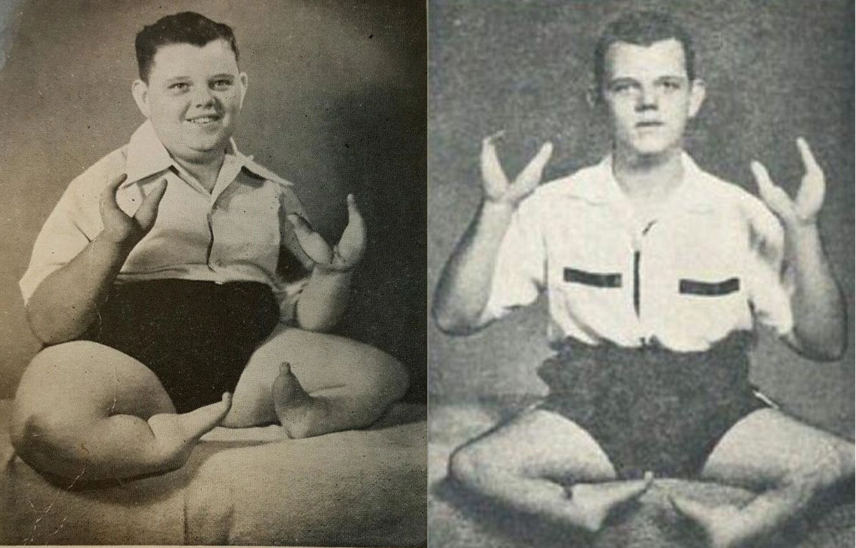 A vida bizarra e a morte planejada pela própria família do Garoto-Lagosta