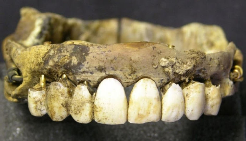 Muitas das dentaduras dos séculos 18 e 19 foram feitas com os dentes dos soldados mortos em Waterloo 03