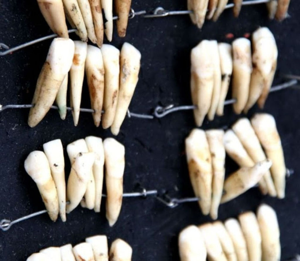 Muitas das dentaduras dos séculos 18 e 19 foram feitas com os dentes dos soldados mortos em Waterloo 07