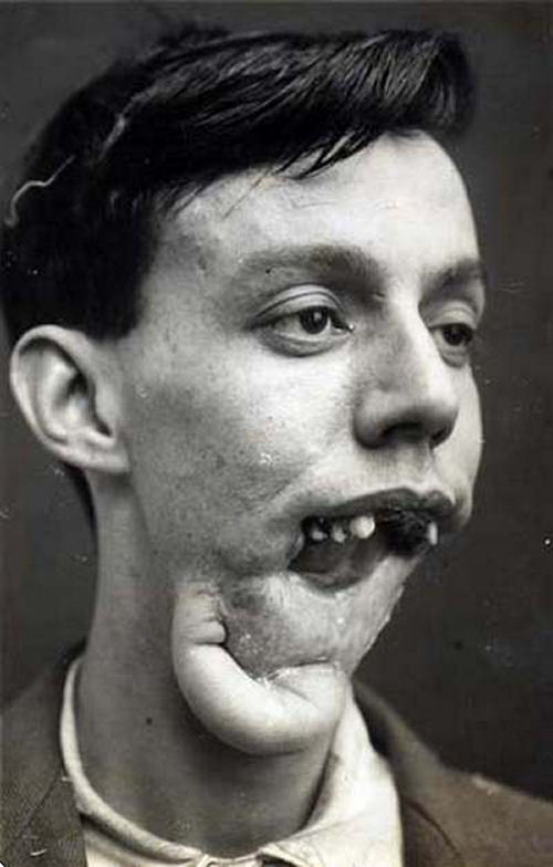 Reconstruindo uma mandbula em 1920 03