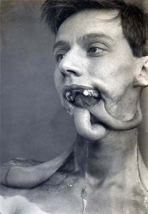 Reconstruindo uma mandbula em 1920 05