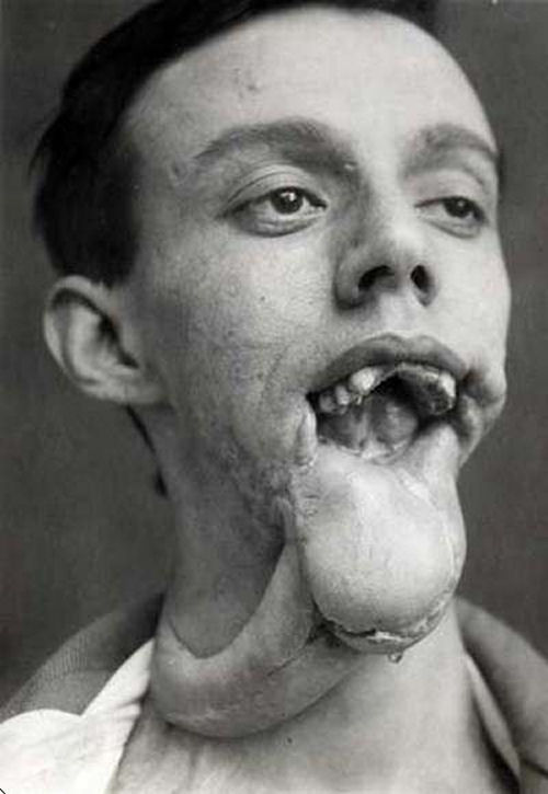 Reconstruindo uma mandbula em 1920 06