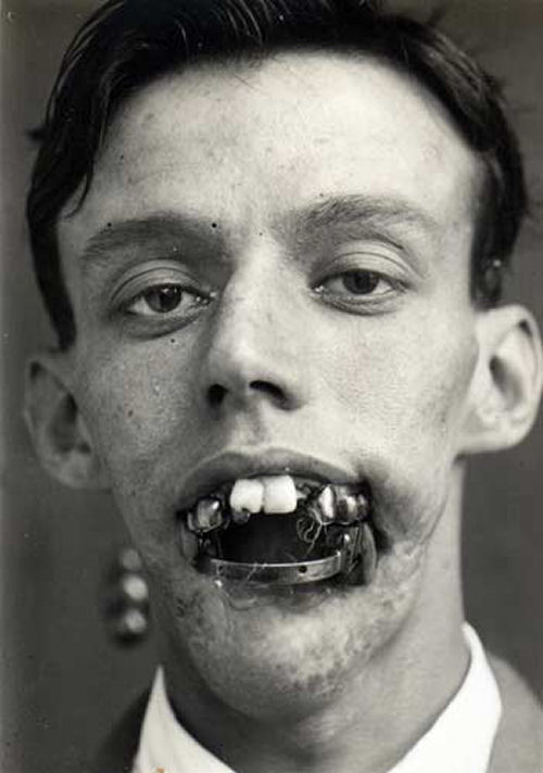 Reconstruindo uma mandbula em 1920 07
