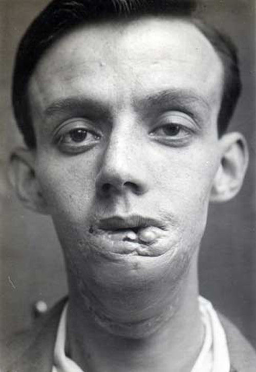 Reconstruindo uma mandbula em 1920 08