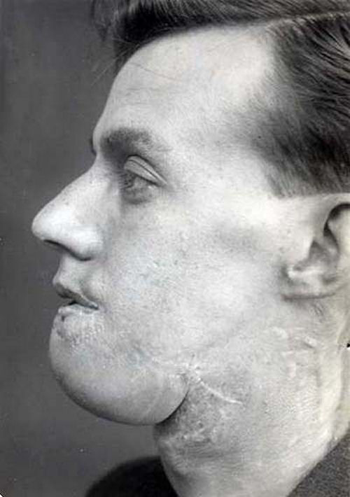 Reconstruindo uma mandbula em 1920 09