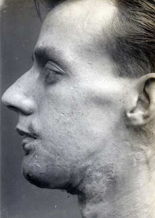 Reconstruindo uma mandbula em 1920 10