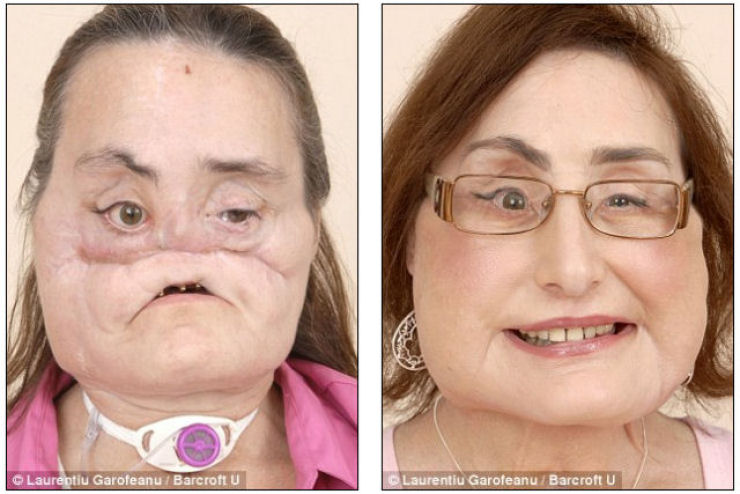 Connie Culp diz que a operao de tranplante facial foi um milagre na sua vida