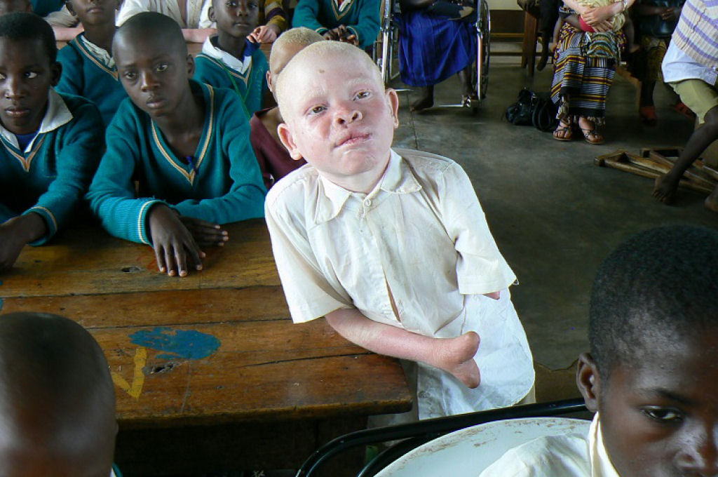 Albinos da Tanznia vivem em constante ameaa de ataque