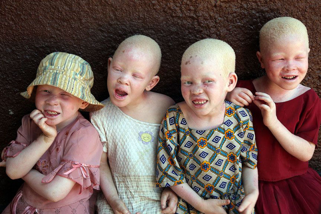 Albinos da Tanz᭩a vivem em constante amea柠de ataque