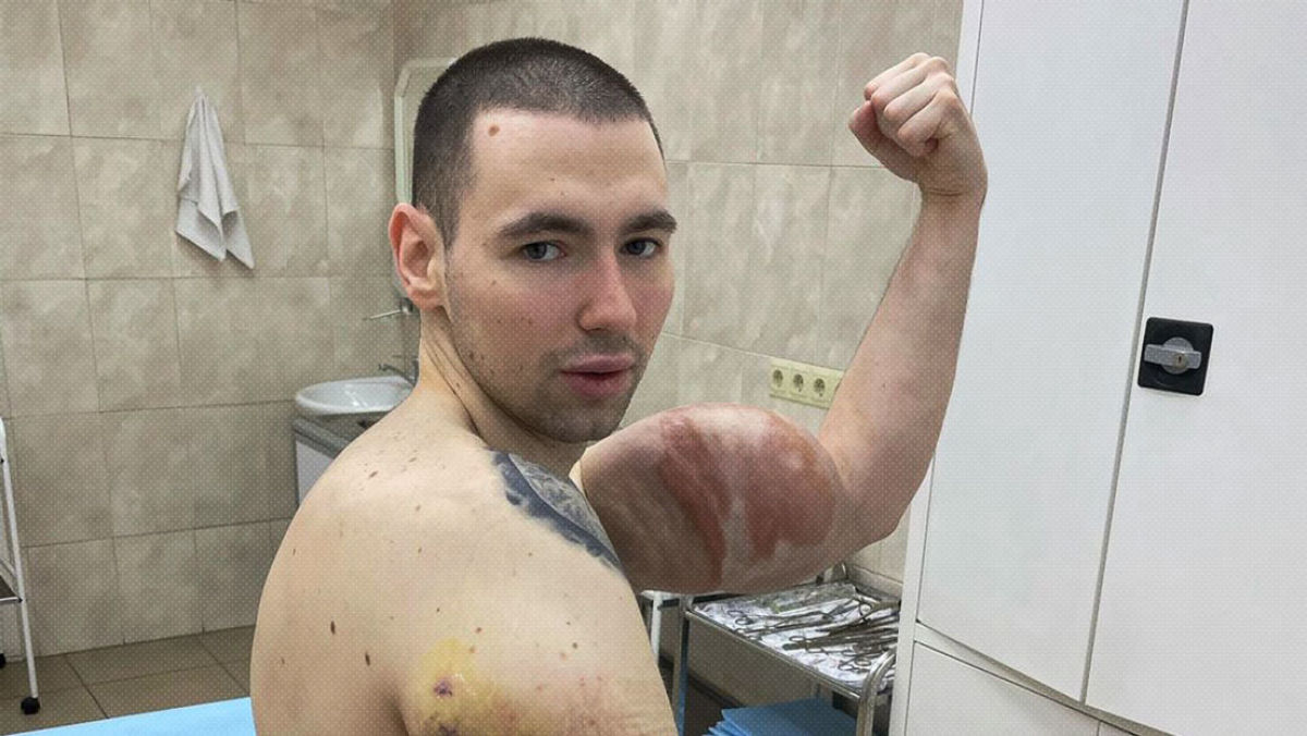 Hulk russo mostra seus braços depois da segunda cirurgia para extrair o Synthol