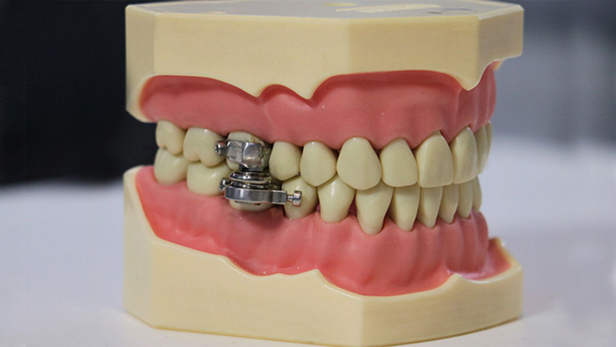 Dispositivo para emagrecer 'cadeando' os dentes parece uma piada ruim