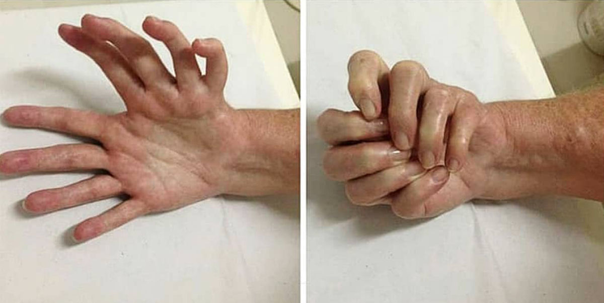 A síndrome da mão-espelhada é tão rara quanto estranha