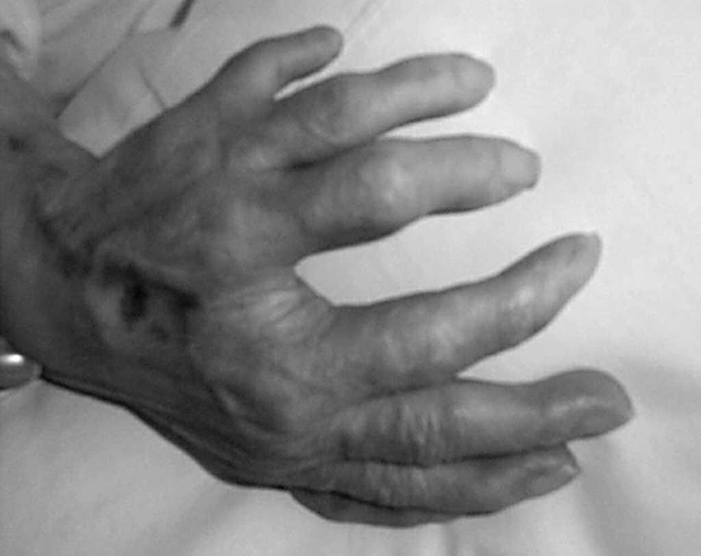 A síndrome da mão-espelhada é tão rara quanto estranha