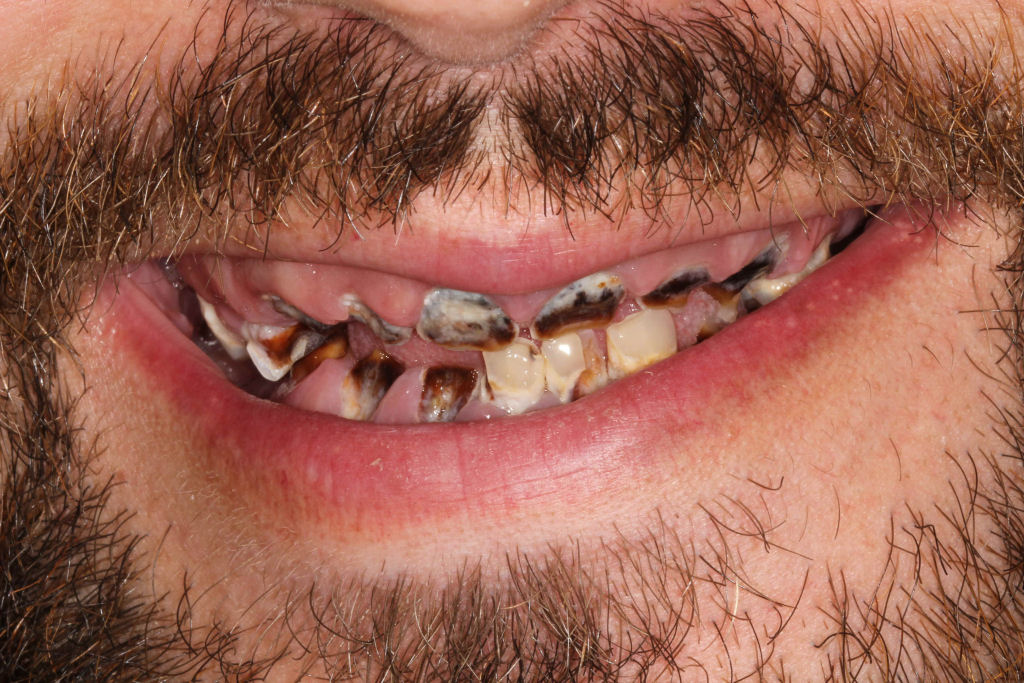 Homem fica quase sem dentes devido a vcio em bebidas efervescentes
