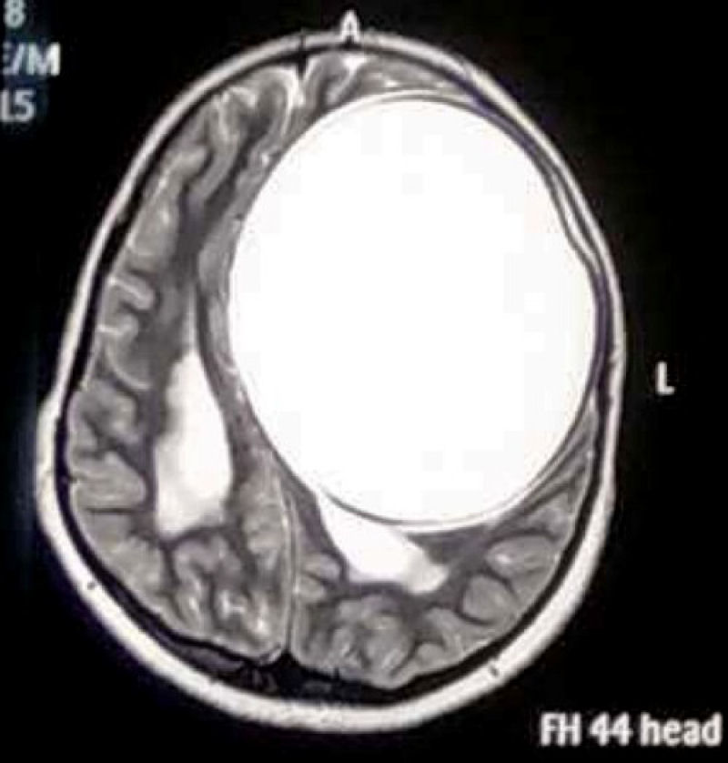 Médicos removem cisto de tênia gigante da cabeça de uma menina, que tinha metade do tamanho do cérebro