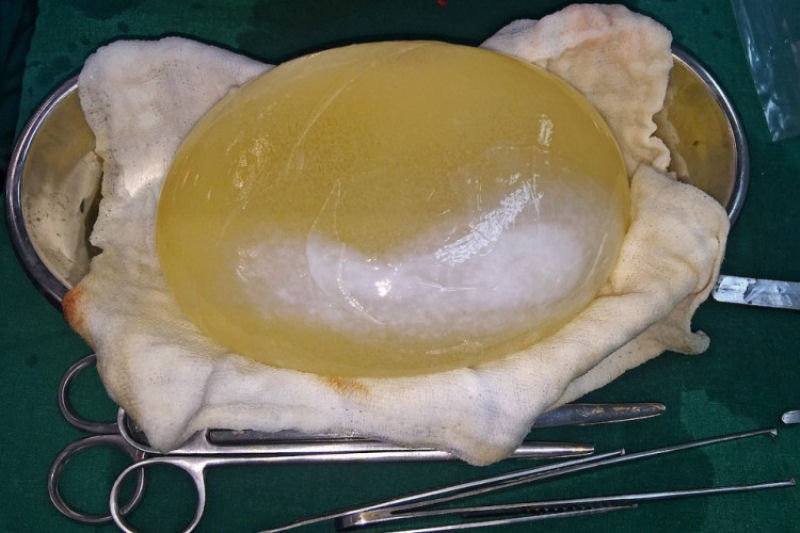 Médicos removem cisto de tênia gigante da cabeça de uma menina, que tinha metade do tamanho do cérebro