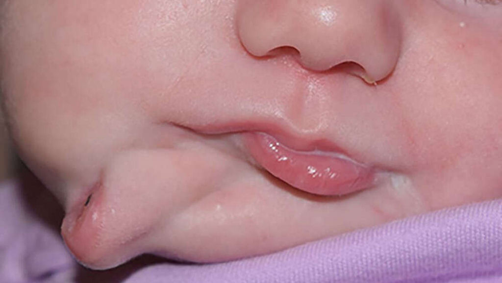 Menina nasce com uma segunda boca, uma estranha e raríssima condição da literatura médica