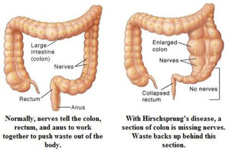 No  um alien,  o caso mais extremo de intestino preso da histria da medicina: a surpreendente doena de Hirschsprung