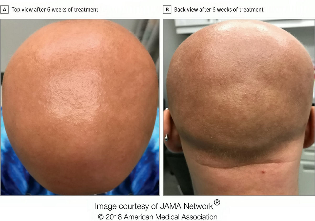 O efeito colateral de um remdio para eczema devolveu o cabelo a uma paciente careca